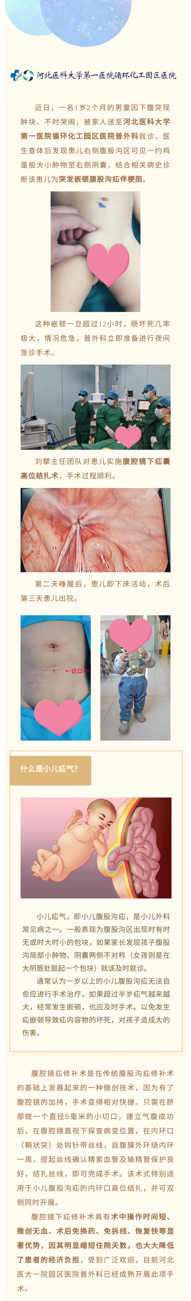 腹腔鏡微創(chuàng)手術(shù)治療小兒疝氣——切口5毫米！手術(shù)→活動，僅半天！-1.jpg
